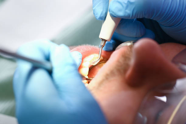 Best Emergency Treatment for Dental Infections or Abscesses in Lake Mohegan, NY